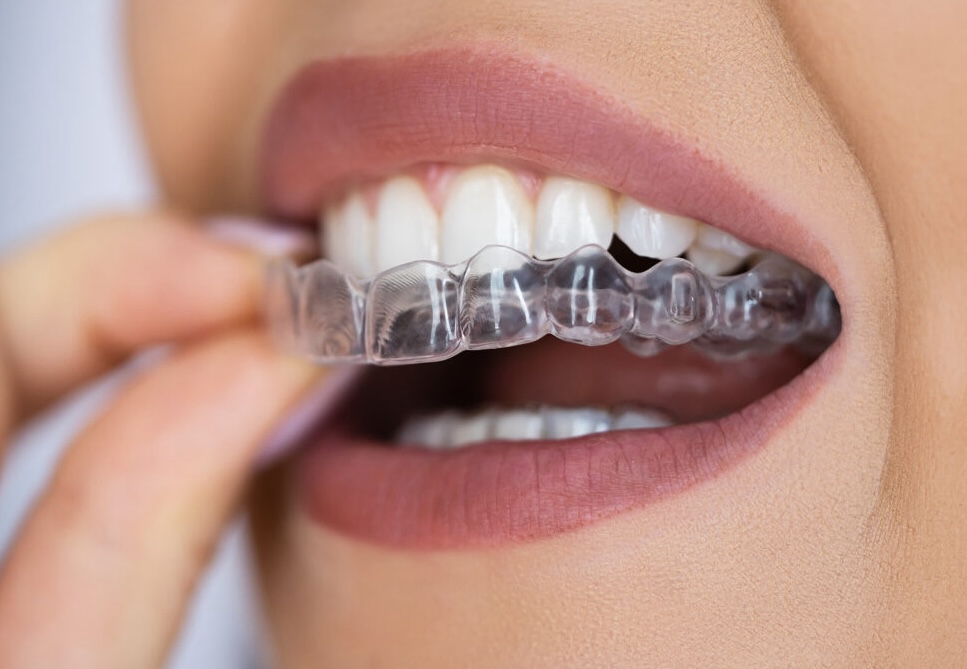 Invisible Aligners