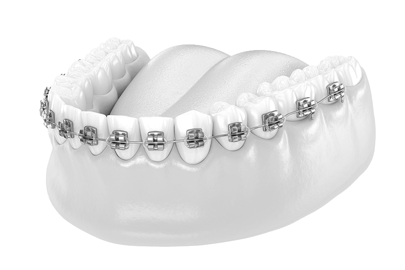 Braces