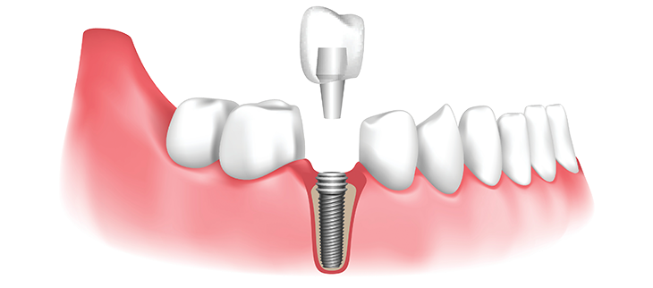 Implant