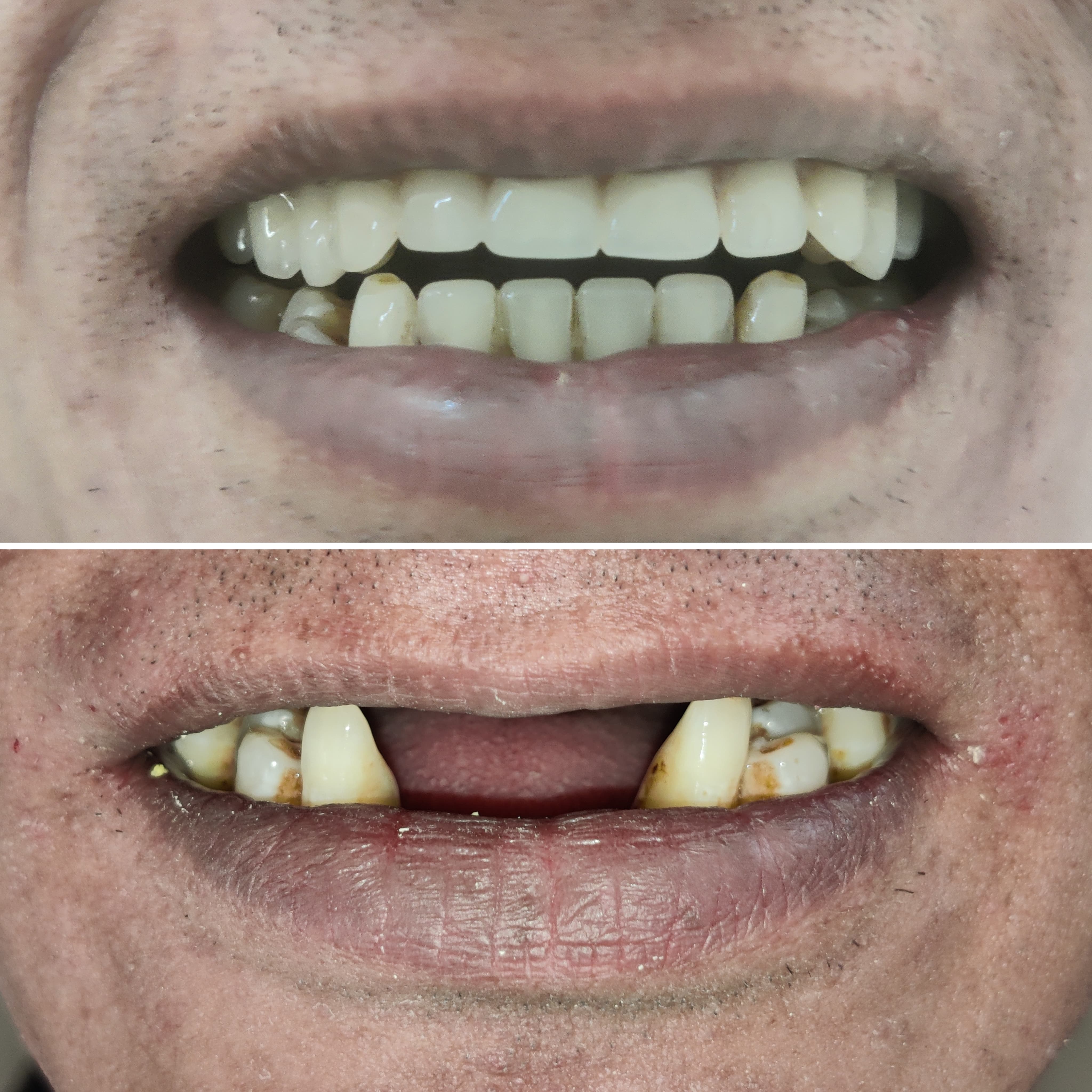Multiple Missing Tooth replacement