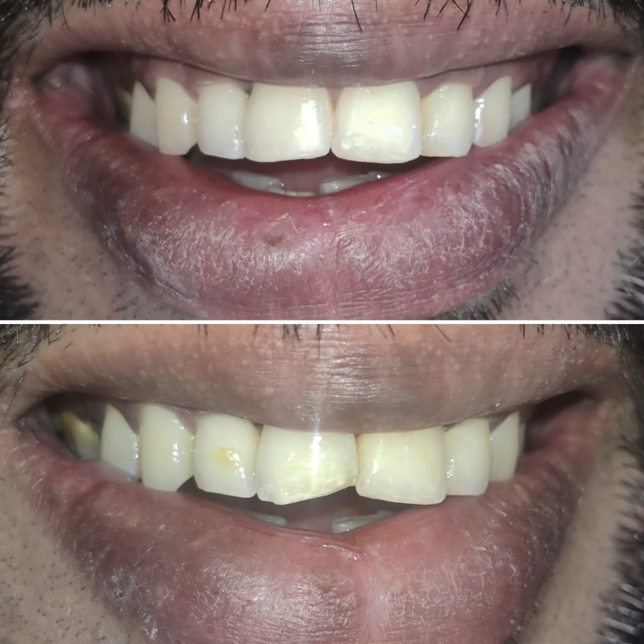Smile design