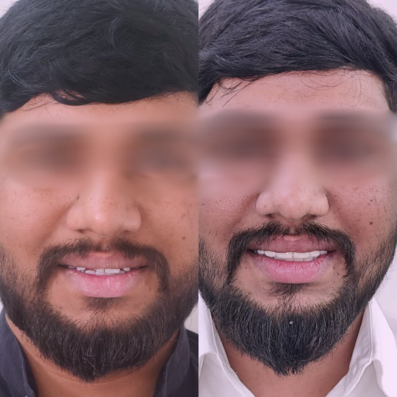 Smile design
