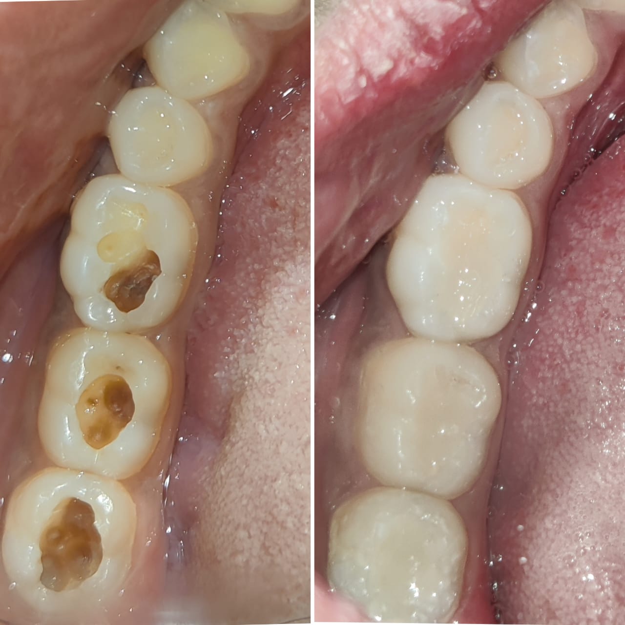 Cavity fillings