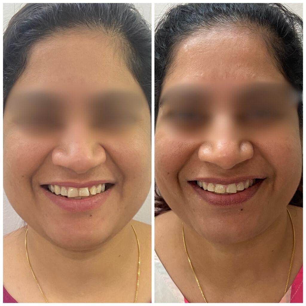 Teeth shaping