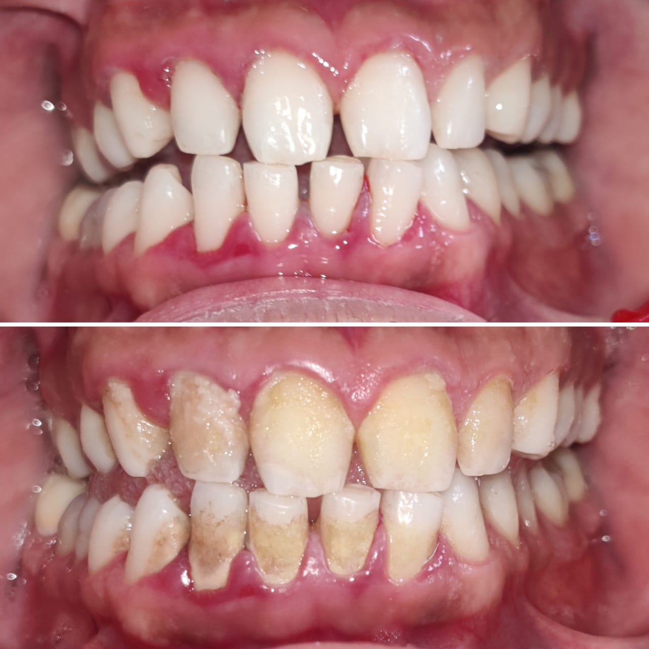 Scaling and polishing
