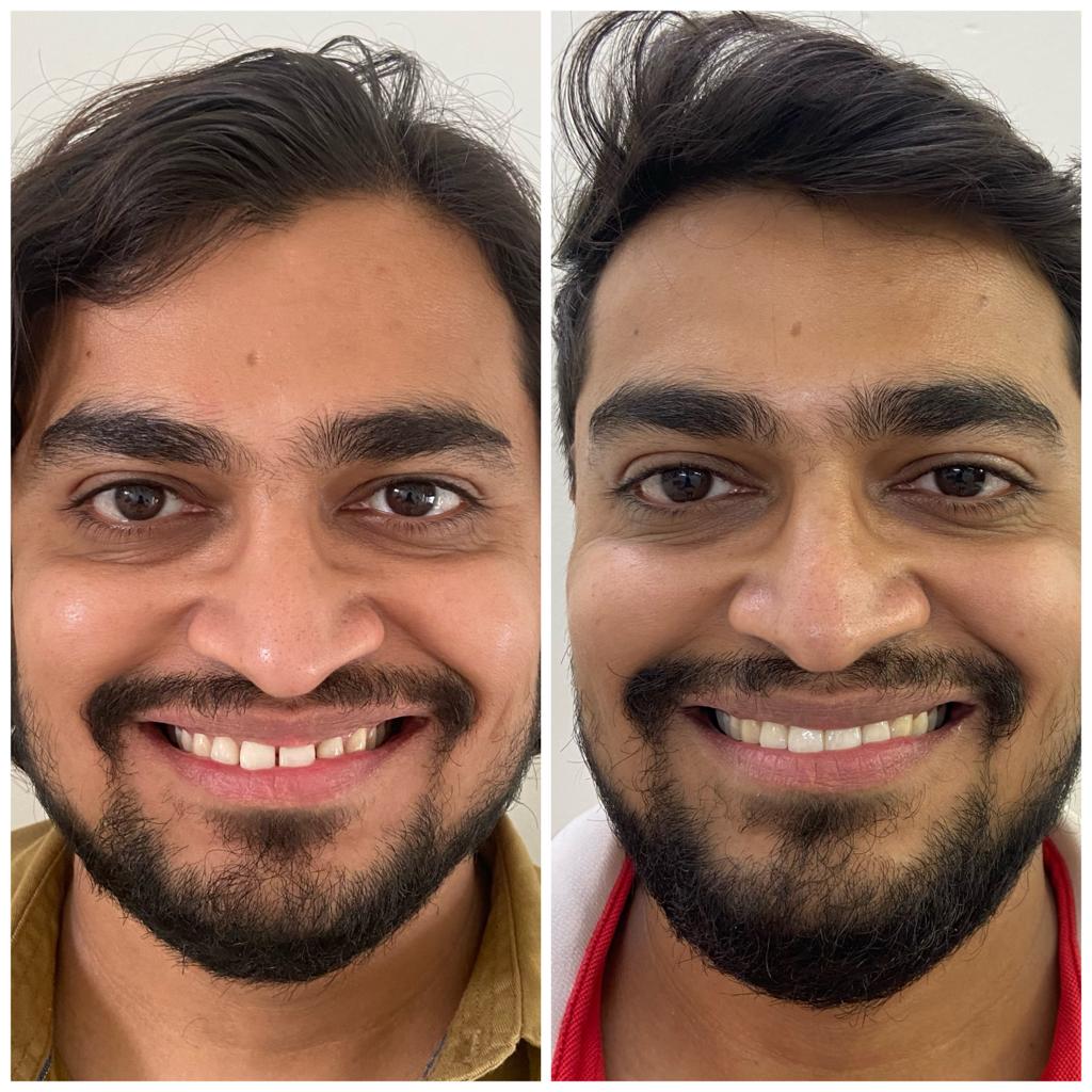 Smile correction using Invisible aligners