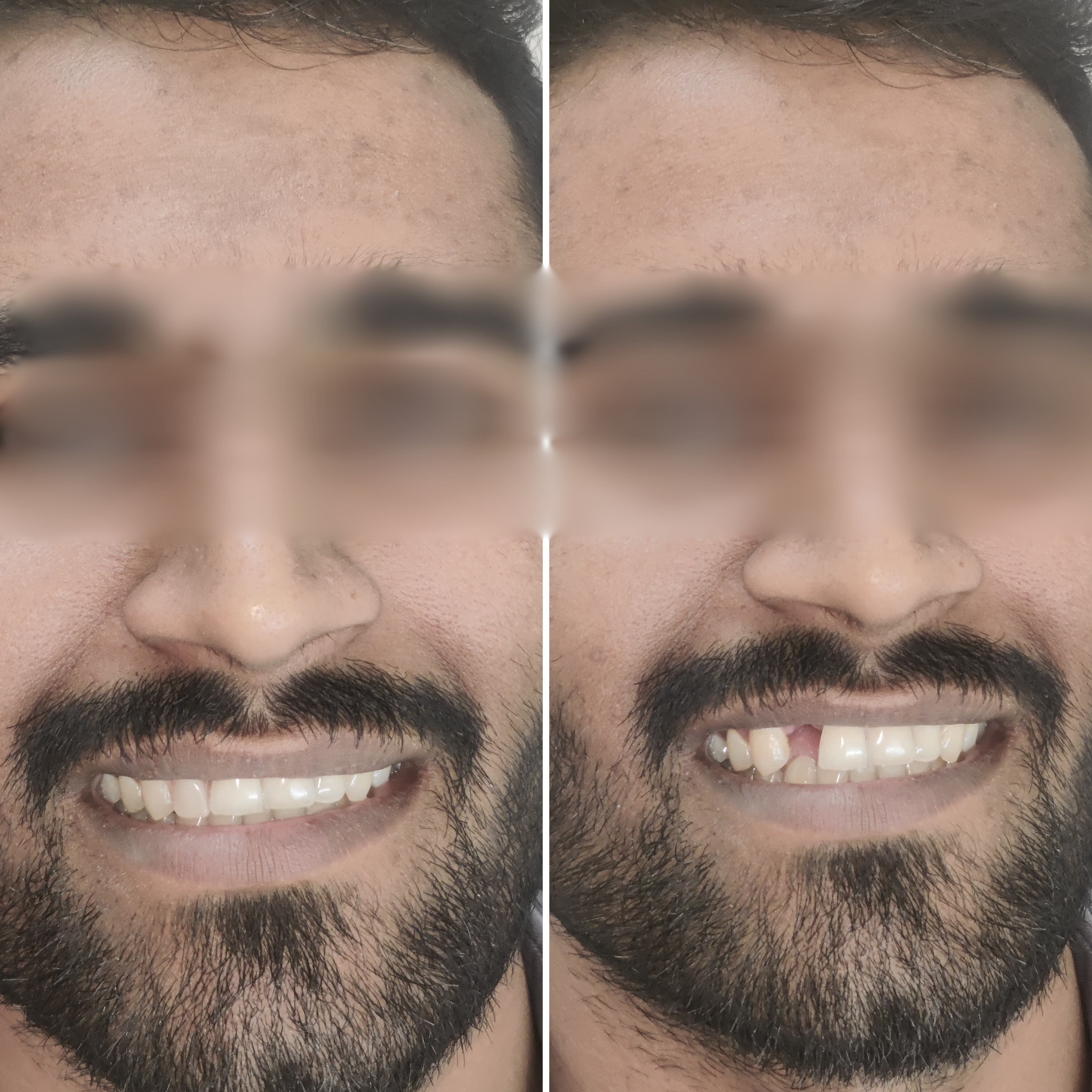 Missing Tooth replacement